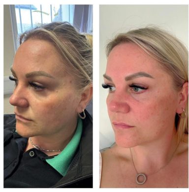 before & after 1 session of AesPLLA